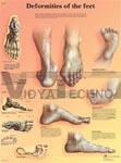 Deformities of the Feet - Anatomical Chart